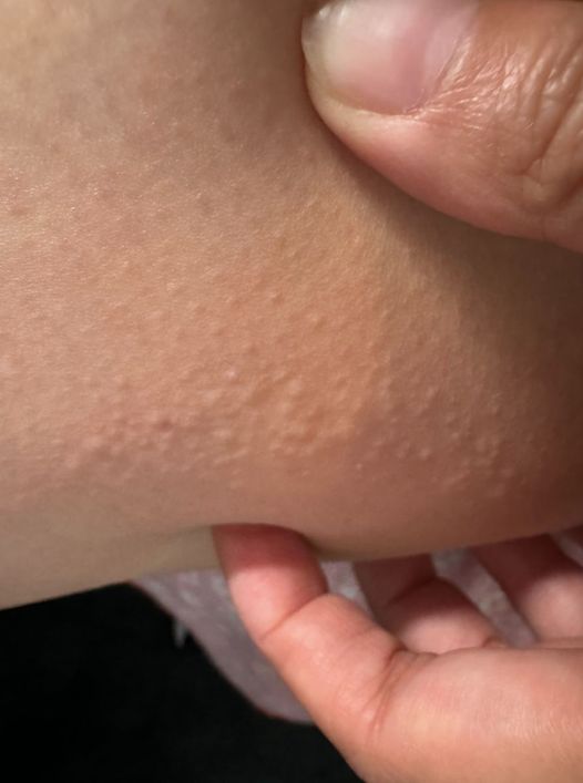 I got these tiny raised bumps on legs. What are they and what should I do about it?